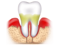 Gingivitis